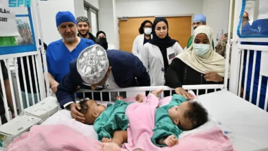 انطلاق إجراءات فصل التوأم الصومالي رحمة ورملا في الرياض